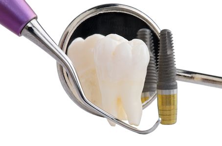 dental implant screw, fake tooth, and dental tools