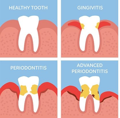 Illustration of the stages of gum disease